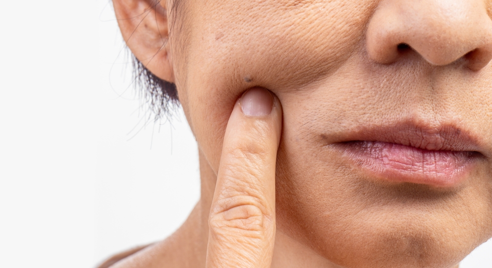 Cancer de la peau du visage : les signes à ne pas ignorer chez les seniors