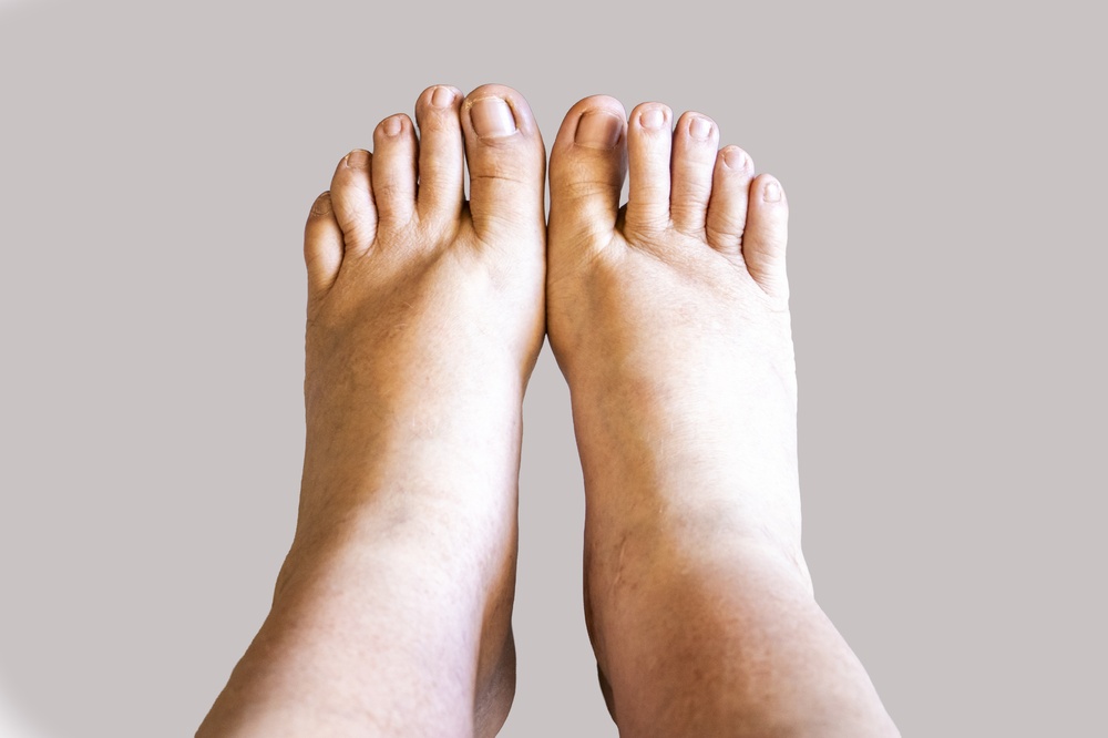 seniors-comment-reduire-naturellement-la-retention-deau-dans-les-jambes