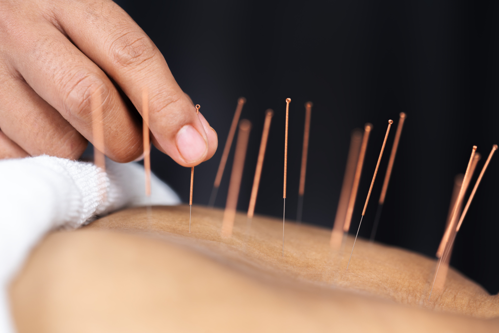Quels sont les bienfaits de l’acupuncture pour les seniors ?